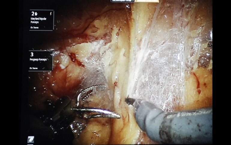 El dispositivo para 'suturar tejido' cuenta con brazos que llegan a las aberturas más pequeñas en el cuerpo. NTX / ARCHIVO