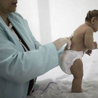 Puerto Rico reporta primer caso de microcefalia relacionado a zika