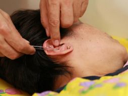 El procedimiento consiste en introducir agujas en puntos específicos de la piel para reducir la frecuencia de los dolores de cabeza. EL INFORMADOR / ARCHIVO