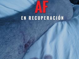 En la imagen se aprecia la pierna izquierda del cantante, con un pequeño orificio sangrando a la altura de la pantorilla. TWITTER / @alexoficial