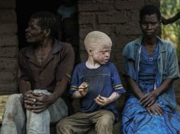 En el país africano, existe la creeencia de que las personas albinas practican brujería y de que dentro de sus huesos hay oro. AFP / ARCHIVO