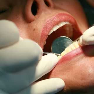 Blanqueamiento dental debe hacerse únicamente con especialista