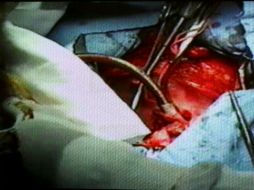 El promedio de espera para un trasplante en el Hospital Civil es de año y medio. NTX / ARCHIVO