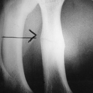 Fracturas por osteoporosis pueden ser incapacitantes
