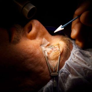 Nueva técnica evita complicaciones en los trasplantes de córnea