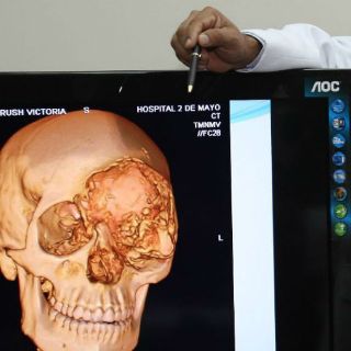 Desarrollan dispositivo para cultivar tumores en 3D