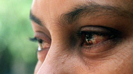 La conjuntivitis es súper común y afecta a tres millones de personas al año. EL INFORMADOR / ARCHIVO