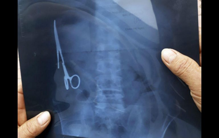 Las tijeras se encontraban oxidadas, en la parte izquierda del estómago. EFE /