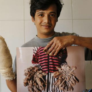 Médicos esperan dar el alta al ‘hombre árbol’ en un mes