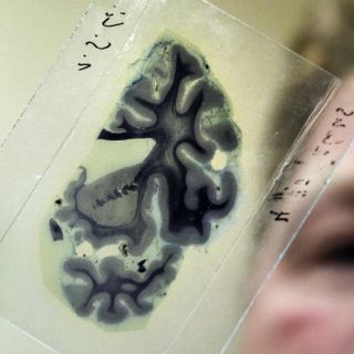 Vinculan efecto del estrés en el cerebro con ataques cardíacos