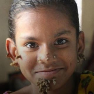 Niña en Bangladesh, diagnosticada con el mal del 'hombre árbol'