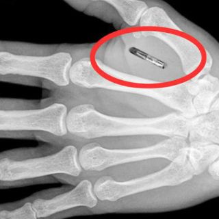 Empresa belga implanta ‘chip’ bajo piel a empleados