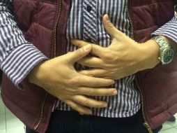 Entre los malestares están: diarrea, fatiga, hinchazón, pérdida de peso, deshidratación y vómito con olor muy fétido. EL INFORMADOR /