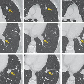 Terapia genética resulta efectiva contra cáncer
