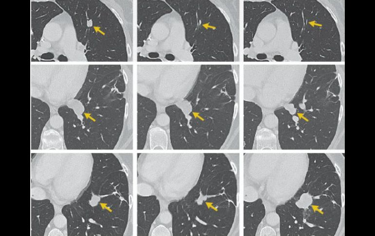 Más de un tercio de enfermos avanzados de linfoma no mostraron señales de la enfermedad seis meses después del tratamiento. TWITTER / @KitePharma
