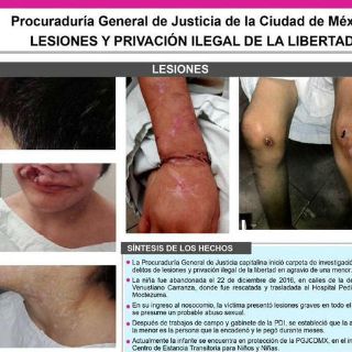 Niña torturada requiere cirugías para recuperar su rostro