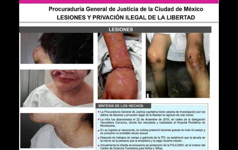 El maltrado impuesto de la abuela hacia la menor fue tan severo que necesitará por los menos cinco cirugías estéticas en el rostro. TWITTER / @PGJDF_CDMX