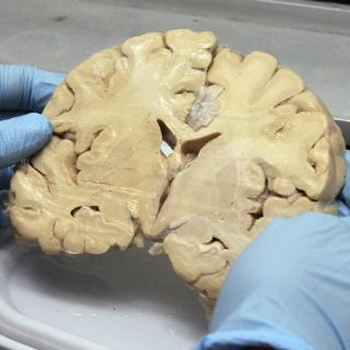 Hablar varios idiomas ayuda a prevenir el Alzheimer