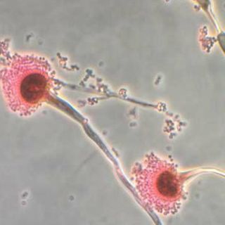 Fiebre y pérdida de conciencia son síntomas de meningitis