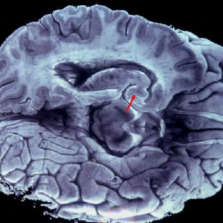 Hemisferios cerebrales desconectados producirían doble personalidad