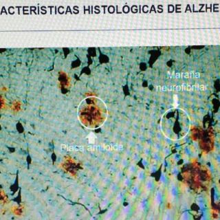 Genes de la esquizofrenia protegen del Alzheimer: estudio