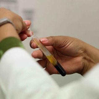 Científicos avanzan contra el ‘mal de las hamburguesas crudas’