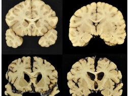 De los cerebros estudiados, 44 son de linieros, 20 corredores, 17 defensivos, 13 linebackers, siete quarterbacks y un pateador. AP / ESPECIAL