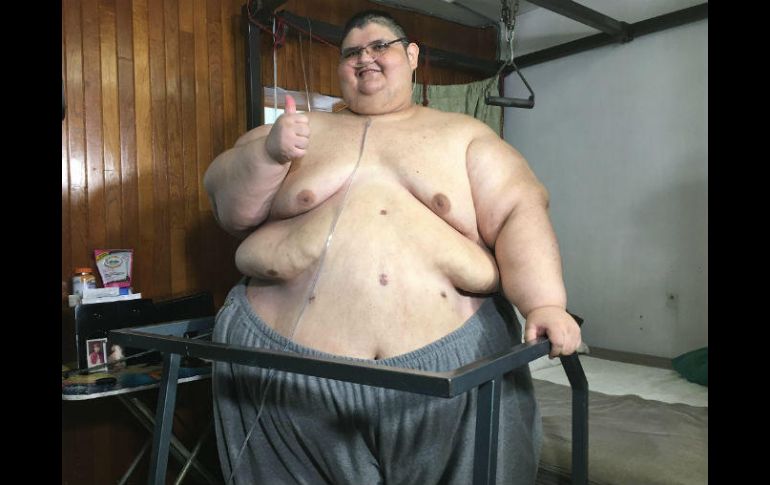 Hoy Juan Pedro pesa 376 kilos, ha perdido 49 desde que le redujeron el estómago. NTX / ESPECIAL