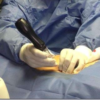 Ozonoterapia, medicina alternativa con múltiples beneficios