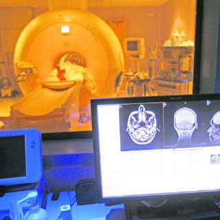 'Ausencias' breves  pueden ser síntoma de epilepsia