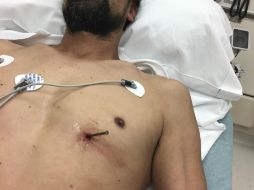 Bergeson fue trasladado a un hospital en Green Bay donde los cirujanos le retiraron el clavo. AP / D. Bergeson