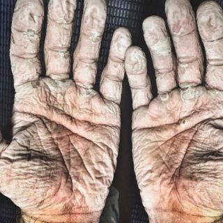 Deportista muestra sus manos tras remar en el Ártico