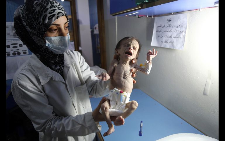 Una enfermera carga a una bebé con desnutrición severa en un hospital de la ciudad siria de Hamouria. AFP/A. Almohibany