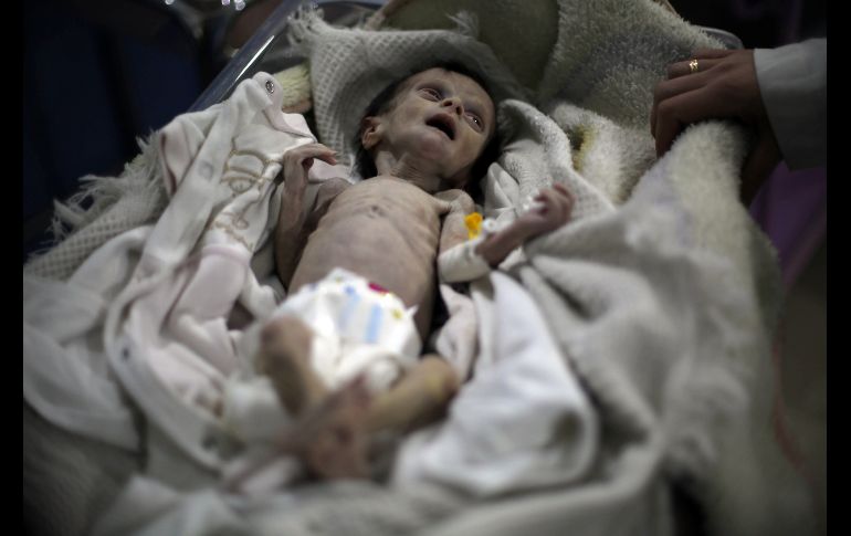 Médicos de la región de Ghouta oriental afirman que examinan diariamente decenas de niños desnutridos. AFP/A. Almohibany