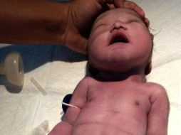 El bebé nació con una rara condición conocida como sirenomelia o 