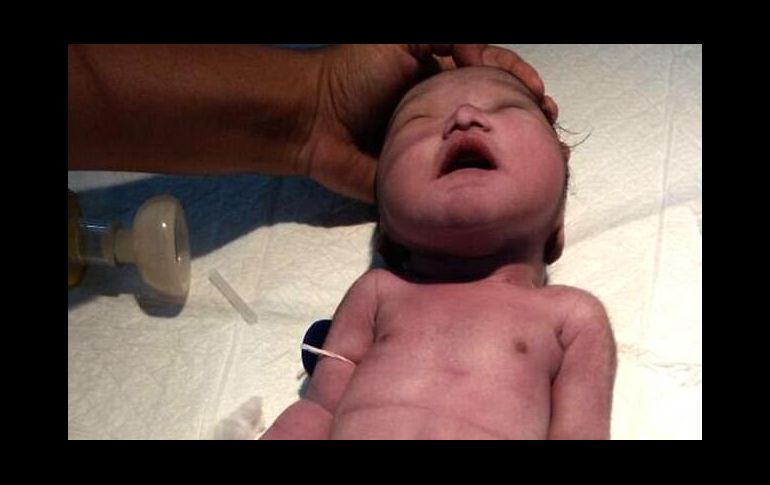 El bebé nació con una rara condición conocida como sirenomelia o 