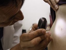 El cáncer de piel está relacionado con la exposición al sol y antecedentes familiares, más bien aquellos pacientes que no se protegieron. NTX / ARCHIVO