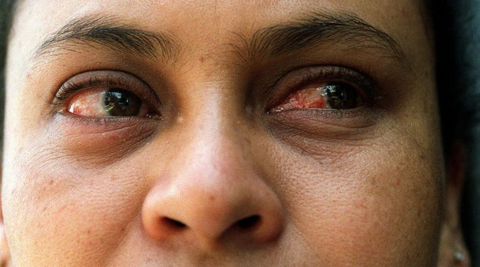 Sugieren a la población acudir al médico ante los primeros síntomas, que son ojo rojo, ardor, comezón y secreciones. EL INFORMADOR / ARCHIVO