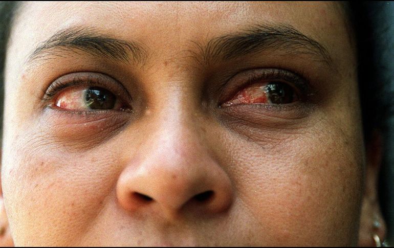 Sugieren a la población acudir al médico ante los primeros síntomas, que son ojo rojo, ardor, comezón y secreciones. EL INFORMADOR / ARCHIVO