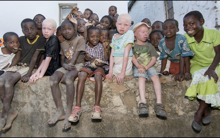 En diversas partes de África aún existe la creencia de que los albinos poseen propiedades mágicas, por lo que la tasa de secuestro y asesinato de este sector es alto. ESPECIAL