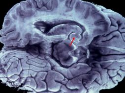 La prueba puede permitir la detección de este padecimiento hasta con 30 años de anticipación. EFE/Archivo