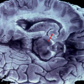 Con muestra de sangre pueden hacer detección temprana de Alzheimer