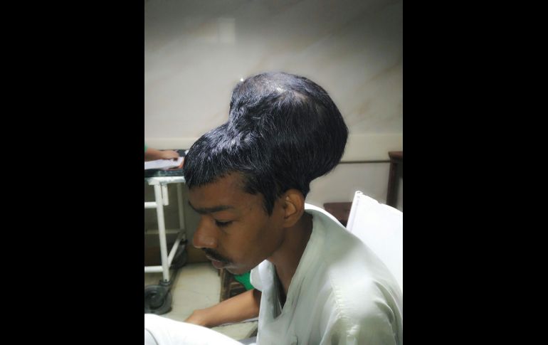 Santlal Pal, 31 años, empleado de una tienda, antes de ser sometido a la operación para extraerle el tumor cerebral. AFP/Department of Neurosurgery Topiwala National Medical College