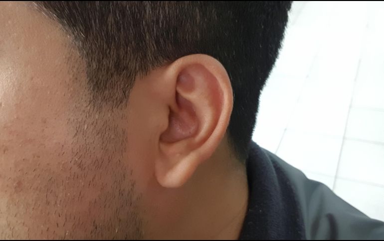 Hay dos causas comunes del vértigo: un virus llamado laberintis, una infección en el oído interno y un problema en los oídos donde los cristales de calcio dentro del oído interno se desplazan. EL INFORMADOR