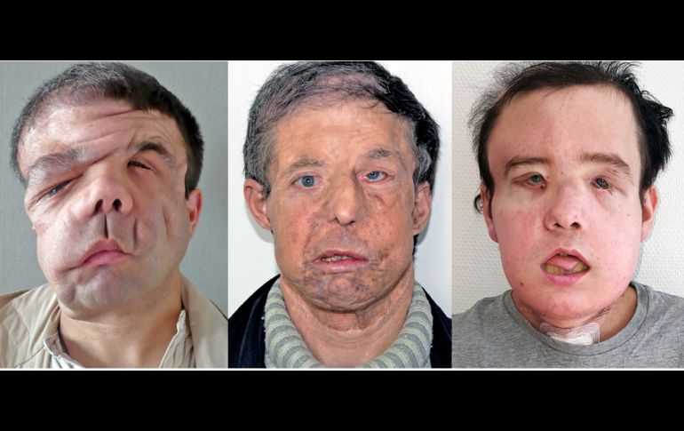El francés padece neurofibromatosis-1, un mal genético que le provocó la deformación del rostro. Imagen de antes (i) y despúes de los trasplantes. AP/HEGP AP-HP