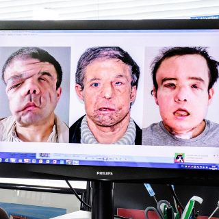 Hombre se adapta a su tercera cara tras nuevo trasplante