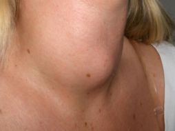 Es un padecimiento más frecuente en las mujeres, con una prevalencia de cuatro casos de pacientes del sexo femenino por cada uno en varones. NTX / ESPECIAL