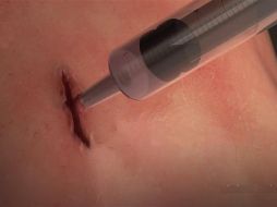 El líder de la investigación indica que hay tres tipos de heridas diferentes: por quemaduras, por objetos punzocortantes o por sustancias químicas. TWITTER / @UNAM_MX