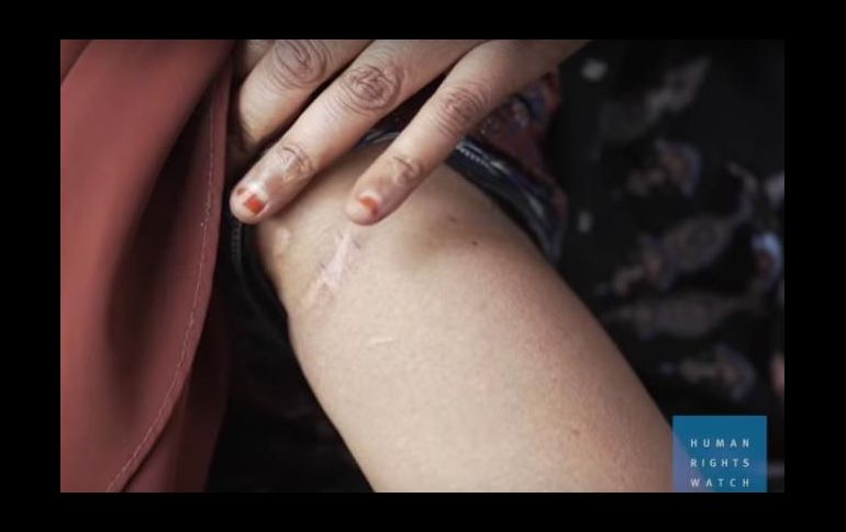Una de las mujeres entrevistadas muestra las cicatrices que le dejaron las golpizas que sufrió en prisión. ESPECIAL/HRW