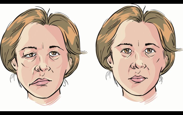 Muestra del rostro tras sufrir una parálisis facial. EL UNIVERSAL